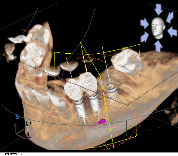 Reconstrucción tridimensional para planificación odontológica del material institucional de D.O.C.